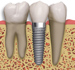 implantes dentales en lima implantes dentales en lima